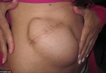 Ajudante de motorista atingido por enxadão na cabeça tem parte de crânio retirada e guardada no abdômen