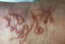 Bicho geográfico: “É melhor prevenir do que remediar”
