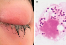 Infecção sexualmente transmissível pode afetar os olhos; entenda o que é a conjuntivite gonocócica e como se proteger