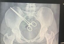 Mulher passa mais de 2 meses com pinça esquecida dentro do corpo após cirurgia