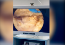Hospital de Base realiza cirurgia inédita para tratar câncer de próstata