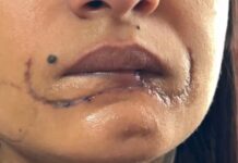 Polícia investiga caso de mulher que perdeu metade do lábio ao ser mordida pelo ex em General Salgado