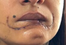 Polícia prende suspeito de agredir e arrancar metade do lábio de ex-companheira em General Salgado