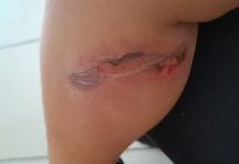 Mãe diz que pediatra desconfiou que queimaduras na perna e partes íntimas de bebê tenham sido provocadas durante banho