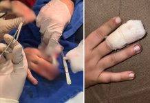 Mãe alega que menino teve dedo esmagado por colegas dentro de escola na região