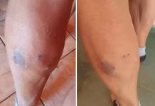 Idosa fica ferida após ser mordida por cão do vizinho na região