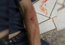 Homem leva mais de 20 pontos ao ser mordido por pit bull em Glicério