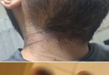 Motociclista tem pescoço e mão cortados por linha de pipa com cerol em Monte Aprazível