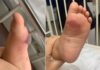 Após ser picada por aranha, criança tem parte da pele do pé retirada em hospital de Rio Preto