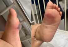 Após ser picada por aranha, criança tem parte da pele do pé retirada em hospital de Rio Preto