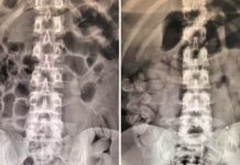 Raio-X mostra cápsulas de cocaína no estômago de quatro bolivianos em Araçatuba