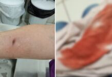 Comerciante fica ferida após ser mordida por cachorro em Jales