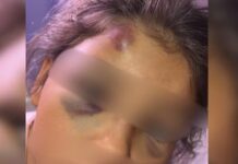 Mãe denuncia suposta agressão em escola após filha chegar em casa com hematomas e inchaço no rosto: ‘Estou sozinha nessa’