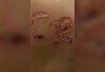 Mulher marcada a ferro quente era mantida em cárcere privado há dois meses em Cosmorama