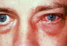 Casos de conjuntivite explodem e Secretaria da Saúde reforça importância da prevenção