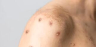 Rio Preto confirma primeiro caso de Mpox em 2026