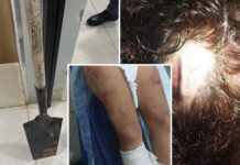 Mulher tem dedo quebrado e sofre cortes na cabeça após ser agredida com pá