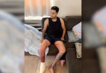 Jovem que teve queimaduras após explosão causada por etanol em tacho recebe alta de hospital: ‘Tempo de recuperação’